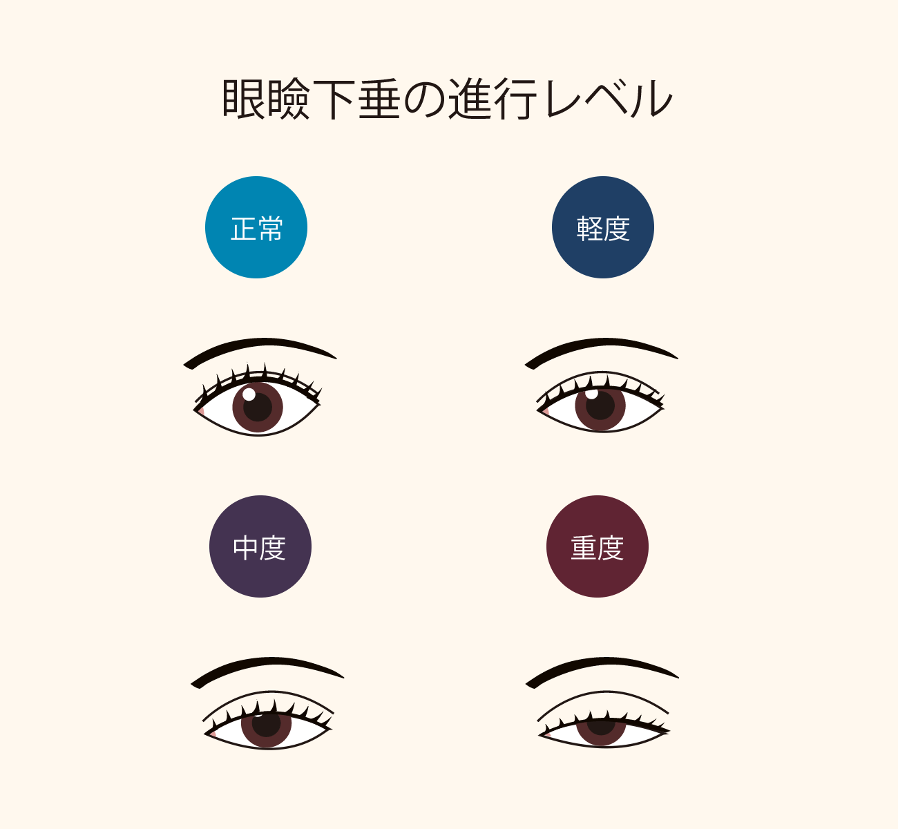 眼瞼下垂の進行レベル イメージ図